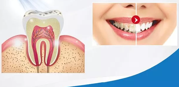 portable LED teeth whitening cool light dental bleaching system device