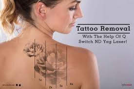 tattoo removal 6.jpg